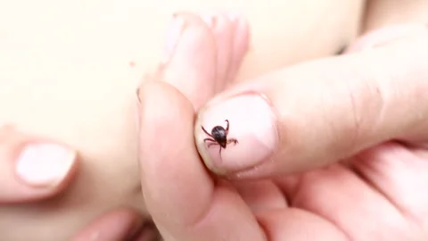 Small Insect Parasite Mite Crawls On a Man's Palm Hand. Tick on the Skin Close Stock Footage 246331112