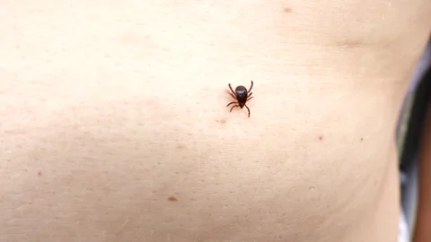 Small Insect Parasite Mite Crawls On a Man's Skin Macro Shot. Tick in Hand Close 스톡 동영상 250560465