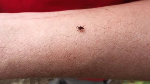 Small Insect Parasite Mite Crawls On a Man's Palm Hand. Tick on the Skin Cl.. Video stock 259905802