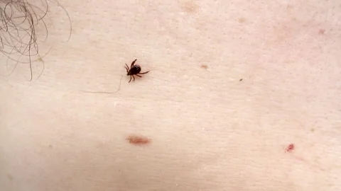 Small Insect Parasite Mite Crawls On a Man's Palm Hand. Tick on the Skin Cl.. Video stock 266298663
