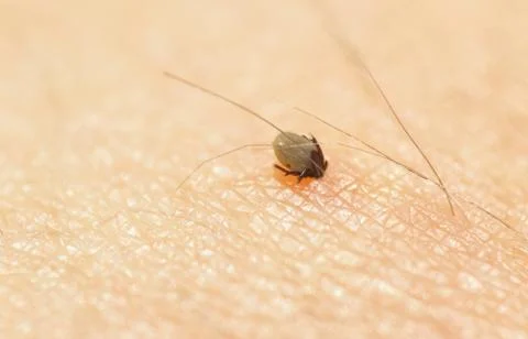 Small Ixodes ricinus bug on human skin sucking blood Stock Photos
