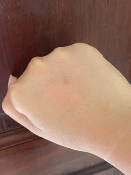 Small Nail Scratch on Hand Stock Photos