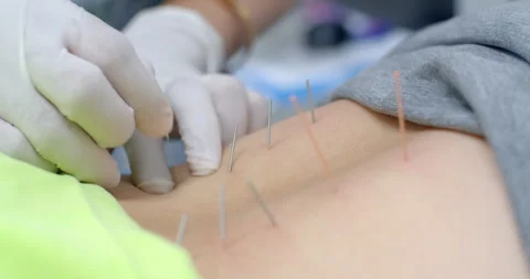 A small needle is inserted into the flesh and pulled in and out to treat muscle  Stock Footage 286423249