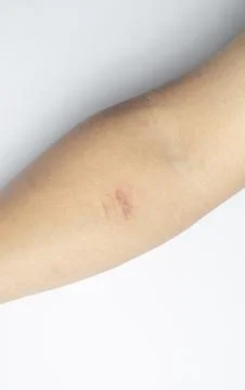 Small Scratch Wound on Human Arm Close Up Stock Photos