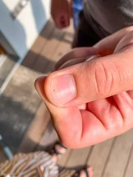 Small tick on a mans nail Stock Photos