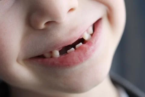 The smile of a boy whose teeth fall out. Change primary teeth for primary tee Stock Photos
