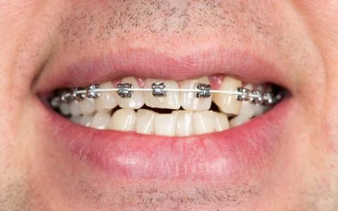 Smile with braces on teeth Stock Photos