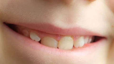 Smile of a child with crooked permanent teeth, crowded teeth, pediatric Stock Footage 330072397