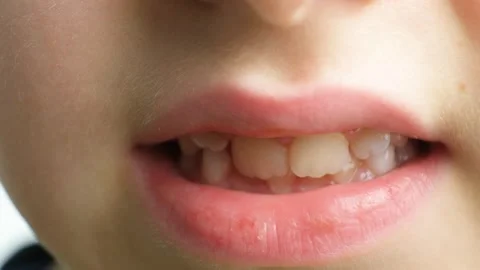 Smile of a child with crooked permanent teeth Видео 330952433