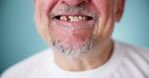 Smile With Missing Tooth Stock Footage 244156161