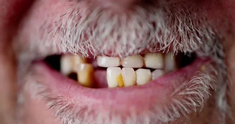 Smile With Missing Tooth Stock Footage 244156204