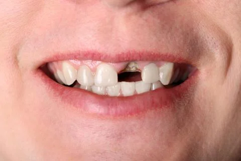 Smile without front tooth Stock Photos