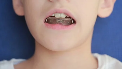 Smiling child with braces on teeth Stock Footage 70675424