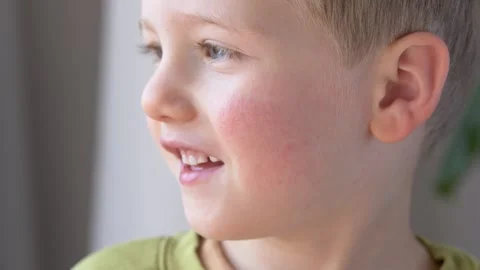 Smiling child with red cheeks and visible rash showing allergy, atopic Stock-Footage 330973451