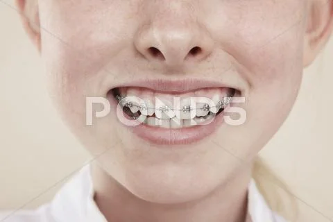 A smiling girl with braces on her teeth, close-up of mouth Stock Photos