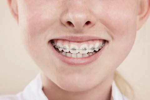 A smiling girl with braces on her teeth, close-up of mouth Stock Photos