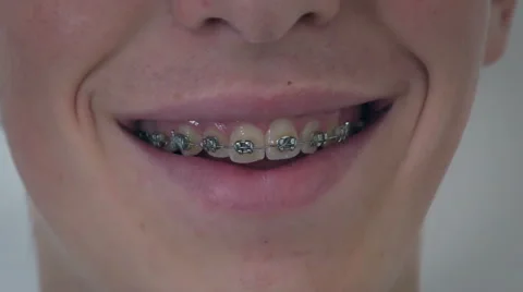 Smiling young boy with braces on teeth, close up Stock-Footage 66244486