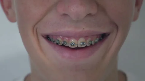 Smiling young boy with braces on teeth, close up 스톡 동영상 66245958