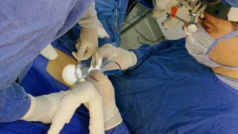 Smoke product of electro surgical scalpel during rib cartilage extraction. Stock Footage