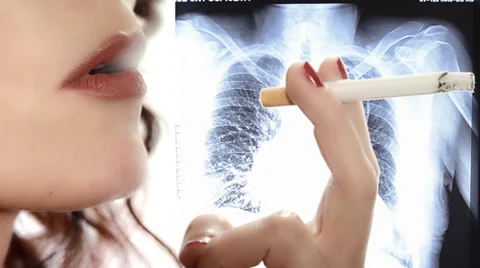 Smoker and x rays 스톡 동영상 33723099