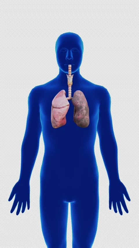 Smoker's Lungs Medical Visualization with Damaged Respiratory System Anatomy Stock Footage 341380997