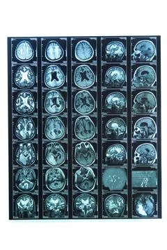 A snapshot of an elderly person's brain scan on magnetic resonance imaging MR Stock Photos