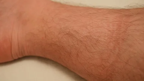 Sock marks on man leg Stock Footage 107012129