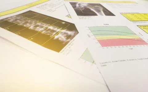 Soft and blurry image: bone density hip and lumbarspine Result Osteoporosis . Stock Photos