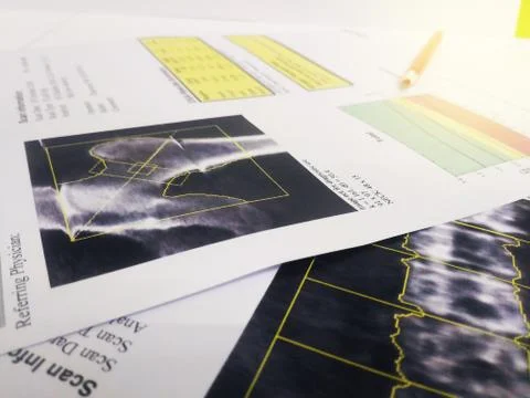 Soft and blurry image:Bone Densitometry hip and lumbarspine Result.on bright  Stock Photos