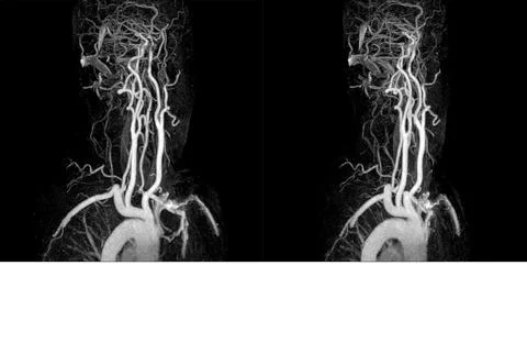Soft and blurry image,Medical image MRI(magnetic resonance venography) Brain  Stock Photos