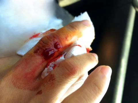 Soft focus the wound was bleeding after a broken glass. Stock Photos