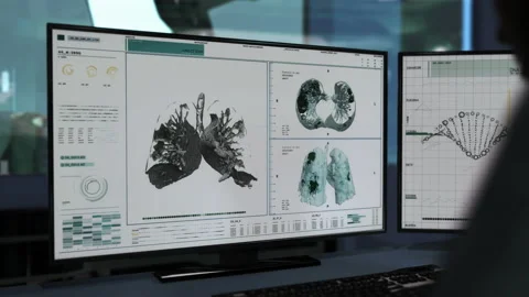 Software tool for image analysis. Lungs scan analysis. Covid-19 pneumonia. UI Stock Footage 211820506