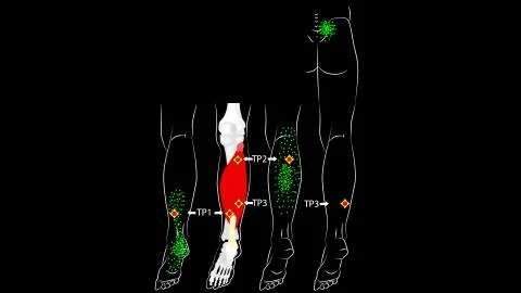Soleus muscle. Trigger points and reflected leg pain. Myofascial release. Stock Illustration