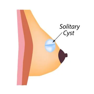 A solid cyst in the mammary gland. World Breast Cancer Day. Solitary cyst Stock Illustration