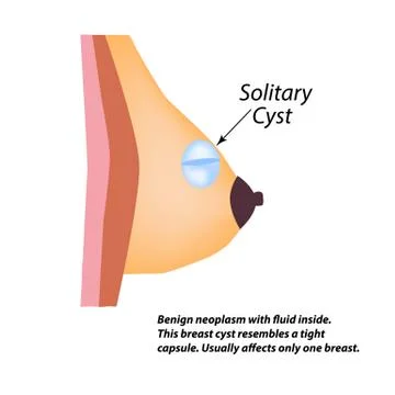 A solid cyst in the mammary gland. World Breast Cancer Day. Solitary cyst Stock Illustration