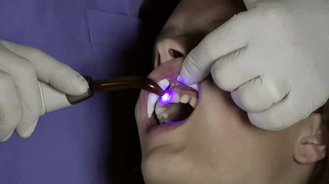 Solidification of a composite operation Video stock 53008076