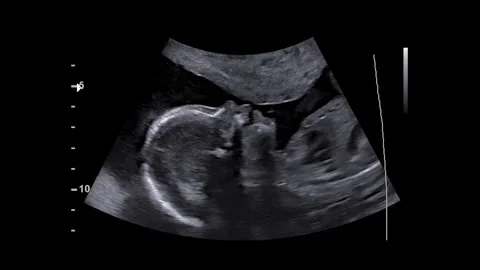 Sonogram of an unborn fetus around at around 20 weeks. Waving hello. Stock Footage 346006078