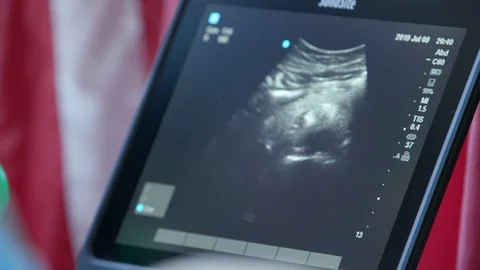 Sonographer draws lines on scan Stock Footage 114181247