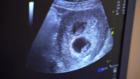 Sonography. The screen of the ultrasound machine. Stock Footage 140455839