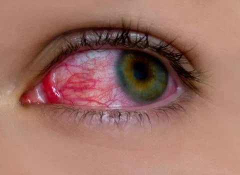Sore eye Stock Photos