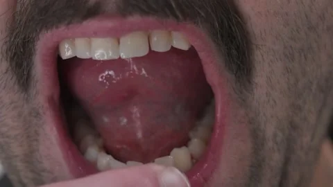 Sore gums in extreme close up after flossing. Stock Footage 314360945
