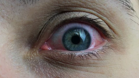 Sore Red Human Eye 스톡 동영상 102461082