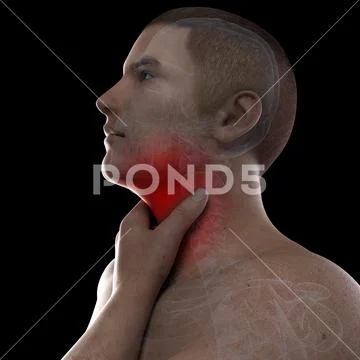 Sore throat, artwork Stock Illustration