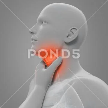 Sore throat, artwork Stock Illustration