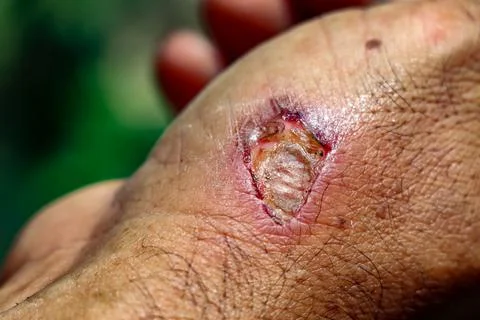 Sores on the hands Stockfoto's