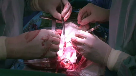 Сoronary artery bypass grafting Stock Footage