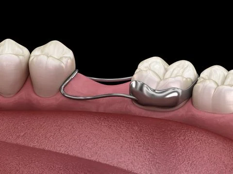 Space Maintainer Unilateral keeps from teeth shift deformatiuon after losing Stock Illustration