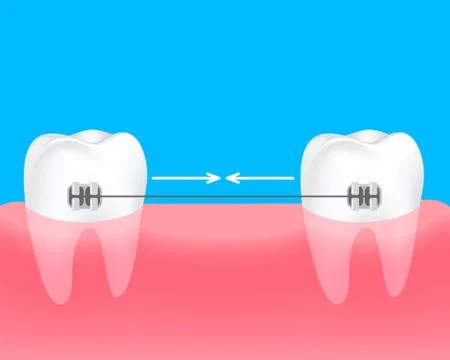 Spacing teeth. Braces to keep the teeth together. Dental care concept. Stock Illustration