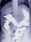 special  examination.com enema Special examination Barium enema A Female 61 year old. Stock Image  #128371671
