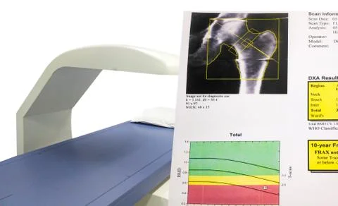 Special examination hip bone density.Result Osteoporosis too blurriness and a Stock Photos